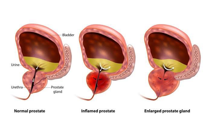 Prostate Artery Embolization