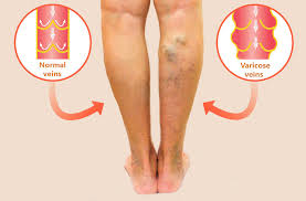 Varicose Veins Doctor in Jaipur, Spider Veins Specialist in Jaipur, Best Thyroid Ablation Specialist in Jaipur, Uterine Fibroid Treatment in Jaipur, Fibroids Surgeon in Jaipur, Dr Manish Rajput, ED Specialist Jaipur