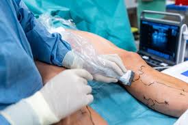 Varicose Veins Doctor in Jaipur, Spider Veins Specialist in Jaipur, Best Thyroid Ablation Specialist in Jaipur, Uterine Fibroid Treatment in Jaipur, Fibroids Surgeon in Jaipur, Dr Manish Rajput, ED Specialist Jaipur