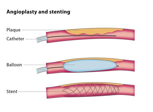 Varicose Veins Doctor in Jaipur, Spider Veins Specialist in Jaipur, Best Thyroid Ablation Specialist in Jaipur, Uterine Fibroid Treatment in Jaipur, Fibroids Surgeon in Jaipur, Dr Manish Rajput, ED Specialist Jaipur