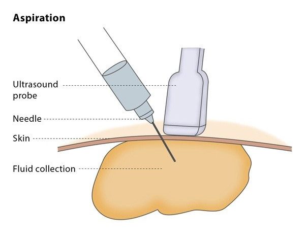 Varicose Veins Doctor in Jaipur, Spider Veins Specialist in Jaipur, Best Thyroid Ablation Specialist in Jaipur, Uterine Fibroid Treatment in Jaipur, Fibroids Surgeon in Jaipur, Dr Manish Rajput, ED Specialist Jaipur