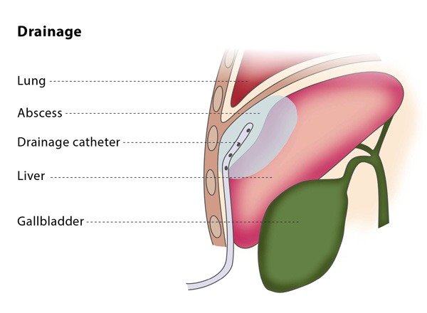 Varicose Veins Doctor in Jaipur, Spider Veins Specialist in Jaipur, Best Thyroid Ablation Specialist in Jaipur, Uterine Fibroid Treatment in Jaipur, Fibroids Surgeon in Jaipur, Dr Manish Rajput, ED Specialist Jaipur