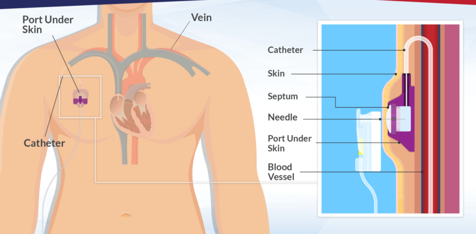 Varicose Veins Doctor in Jaipur, Spider Veins Specialist in Jaipur, Best Thyroid Ablation Specialist in Jaipur, Uterine Fibroid Treatment in Jaipur, Fibroids Surgeon in Jaipur, Dr Manish Rajput, ED Specialist Jaipur