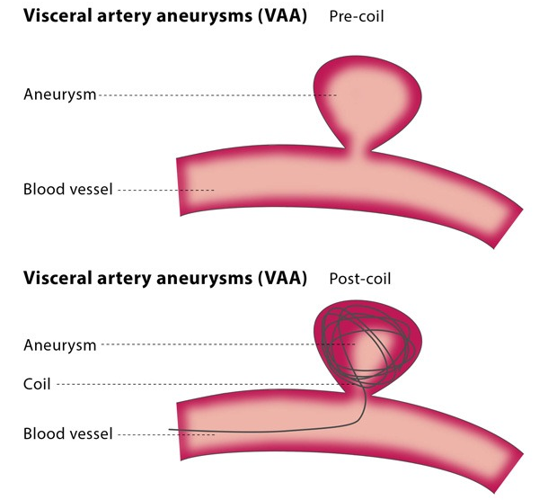 Varicose Veins Doctor in Jaipur, Spider Veins Specialist in Jaipur, Best Thyroid Ablation Specialist in Jaipur, Uterine Fibroid Treatment in Jaipur, Fibroids Surgeon in Jaipur, Dr Manish Rajput, ED Specialist Jaipur