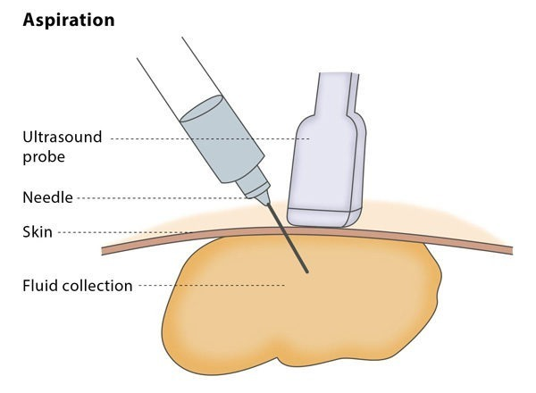 Varicose Veins Doctor in Jaipur, Spider Veins Specialist in Jaipur, Best Thyroid Ablation Specialist in Jaipur, Uterine Fibroid Treatment in Jaipur, Fibroids Surgeon in Jaipur, Dr Manish Rajput, ED Specialist Jaipur