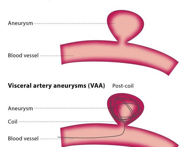 Varicose Veins Doctor in Jaipur, Spider Veins Specialist in Jaipur, Best Thyroid Ablation Specialist in Jaipur, Uterine Fibroid Treatment in Jaipur, Fibroids Surgeon in Jaipur, Dr Manish Rajput, ED Specialist Jaipur