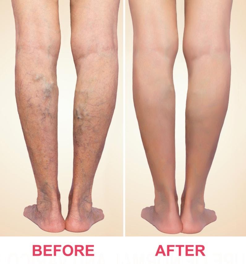 Varicose Veins Doctor in Jaipur, Spider Veins Specialist in Jaipur, Best Thyroid Ablation Specialist in Jaipur, Uterine Fibroid Treatment in Jaipur, Fibroids Surgeon in Jaipur, Dr Manish Rajput, ED Specialist Jaipur