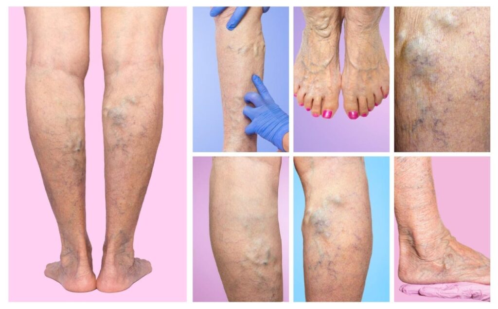 Varicose Veins Doctor in Jaipur, Spider Veins Specialist in Jaipur, Best Thyroid Ablation Specialist in Jaipur, Uterine Fibroid Treatment in Jaipur, Fibroids Surgeon in Jaipur, Dr Manish Rajput, ED Specialist Jaipur