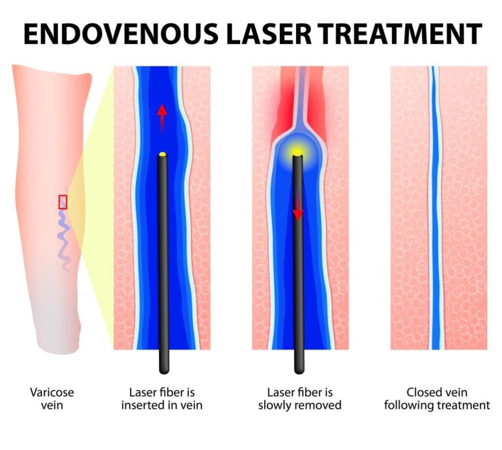 Varicose Veins Doctor in Jaipur, Spider Veins Specialist in Jaipur, Best Thyroid Ablation Specialist in Jaipur, Uterine Fibroid Treatment in Jaipur, Fibroids Surgeon in Jaipur, Dr Manish Rajput, ED Specialist Jaipur