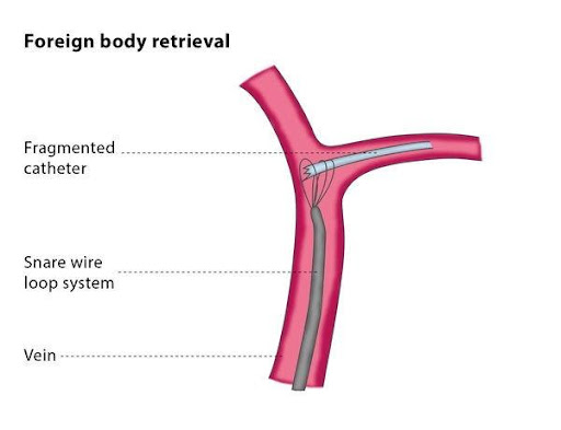 Varicose Veins Doctor in Jaipur, Spider Veins Specialist in Jaipur, Best Thyroid Ablation Specialist in Jaipur, Uterine Fibroid Treatment in Jaipur, Fibroids Surgeon in Jaipur, Dr Manish Rajput, ED Specialist Jaipur