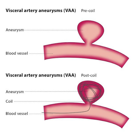 Varicose Veins Doctor in Jaipur, Spider Veins Specialist in Jaipur, Best Thyroid Ablation Specialist in Jaipur, Uterine Fibroid Treatment in Jaipur, Fibroids Surgeon in Jaipur, Dr Manish Rajput, ED Specialist Jaipur