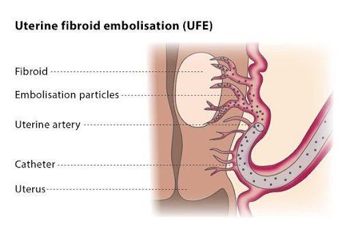 Varicose Veins Doctor in Jaipur, Spider Veins Specialist in Jaipur, Best Thyroid Ablation Specialist in Jaipur, Uterine Fibroid Treatment in Jaipur, Fibroids Surgeon in Jaipur, Dr Manish Rajput, ED Specialist Jaipur